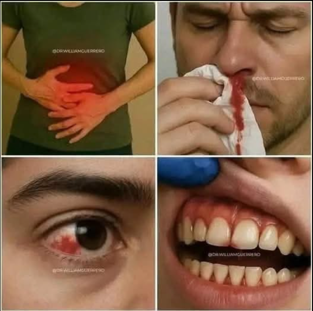 🩸 Estos Síntomas Pueden Alertar Sobre Problemas Graves en tu Sangre