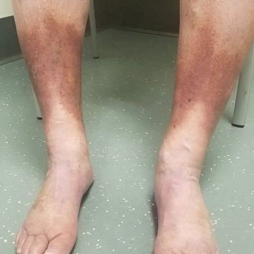 🦶 ¿Tus pies te están avisando? La verdad sobre las manchas oscuras y la hinchazón en los tobillos