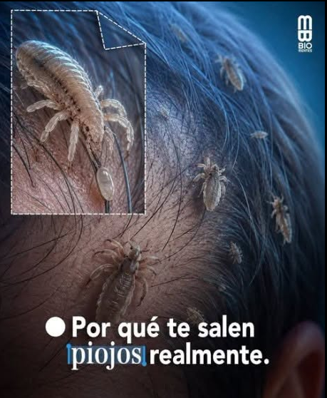 Piojos en la cabeza: Por Qué Aparecen y Como Eliminarlos