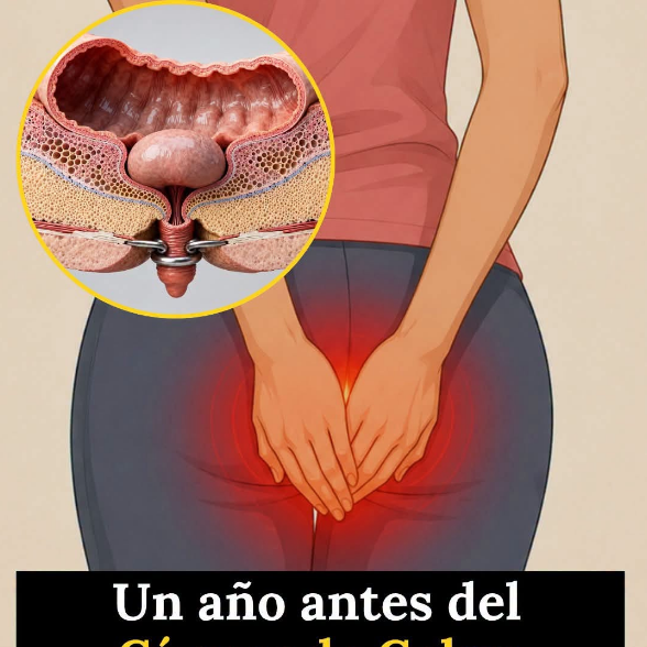 🚽Señales del Cáncer de Colon que Debes Conocer