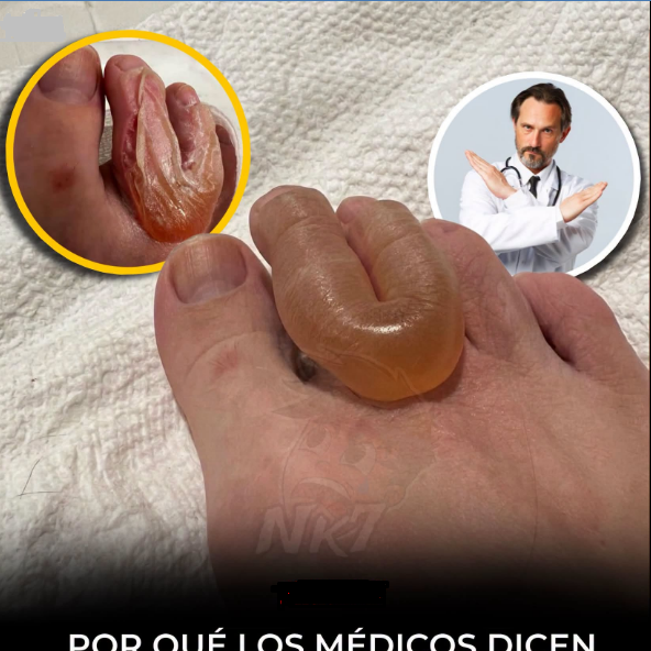 Ampollas o Flictenas: Por que no debes reventarlas