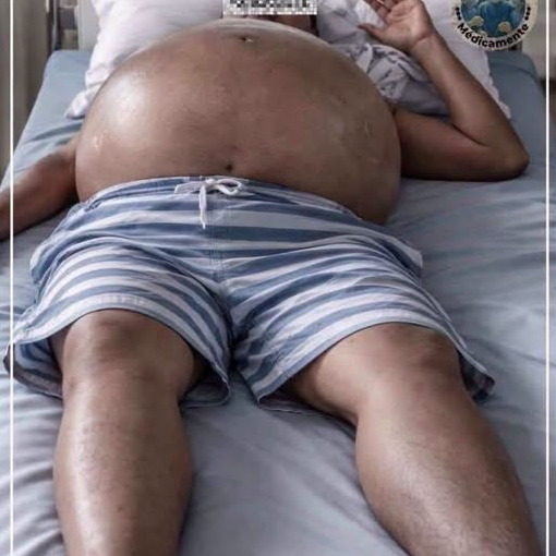 Ascitis: El resultado del Abuso del Alcohol y otras Cosas